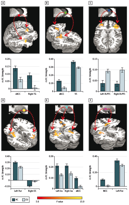 Impaired functional connectivity within and between frontostriatal circuits and its association with compulsive drug use and trait impulsivity in cocaine addiction.